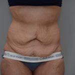 Body Lift Before & After Patient #3179