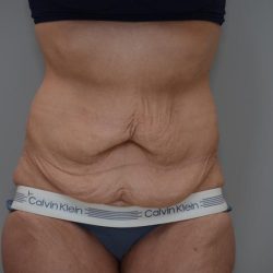 Body Lift Before & After Patient #3179