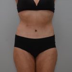 Body Lift Before & After Patient #3179