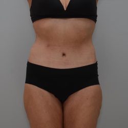 Body Lift Before & After Patient #3179