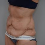 Body Lift Before & After Patient #3179