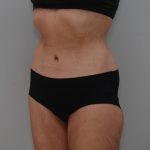 Body Lift Before & After Patient #3179