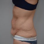 Body Lift Before & After Patient #3179
