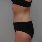 Body Lift Before & After Patient #3179