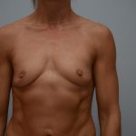 Breast Augmentation Before & After Patient #3180