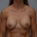 Breast Augmentation Before & After Patient #3180