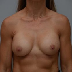 Breast Augmentation Before & After Patient #3180