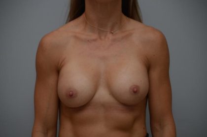 Breast Augmentation Before & After Patient #3180