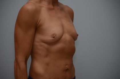 Breast Augmentation Before & After Patient #3180