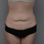 Body Lift Before & After Patient #3181