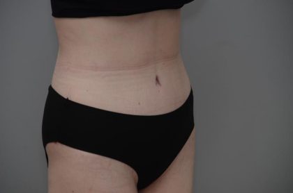 Body Lift Before & After Patient #3181