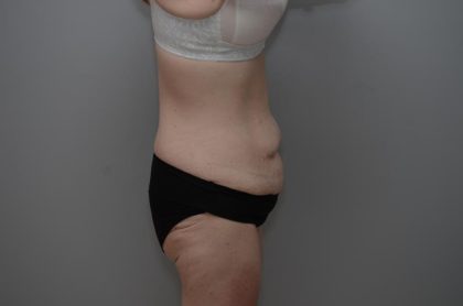 Body Lift Before & After Patient #3181