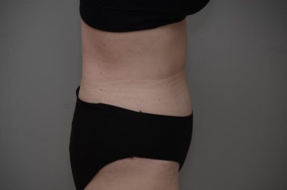 Body Lift Before & After Patient #3181
