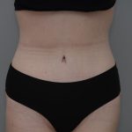 Body Lift Before & After Patient #3181