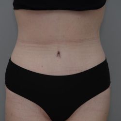 Body Lift Before & After Patient #3181