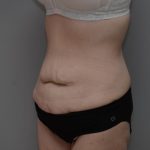 Body Lift Before & After Patient #3181