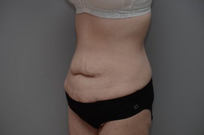 Body Lift Before & After Patient #3181