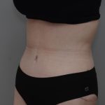Body Lift Before & After Patient #3181