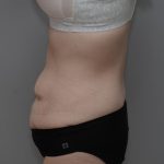 Body Lift Before & After Patient #3181
