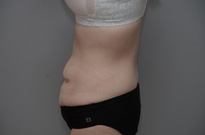 Body Lift Before & After Patient #3181