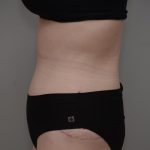Body Lift Before & After Patient #3181