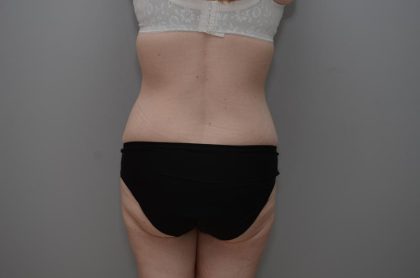 Body Lift Before & After Patient #3181