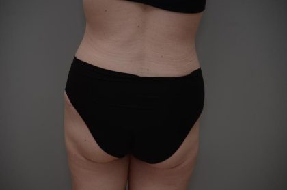 Body Lift Before & After Patient #3181