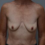 Breast Lift With Implants Before & After Patient #3182