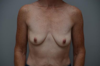 Breast Lift With Implants Before & After Patient #3182