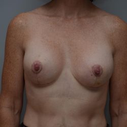 Breast Lift With Implants Before & After Patient #3182