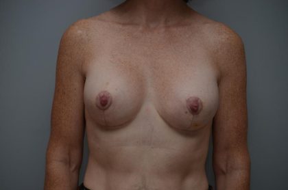 Breast Lift With Implants Before & After Patient #3182