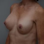 Breast Lift With Implants Before & After Patient #3182