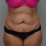 Abdominoplasty Before & After Patient #3185