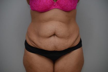 Abdominoplasty Before & After Patient #3185