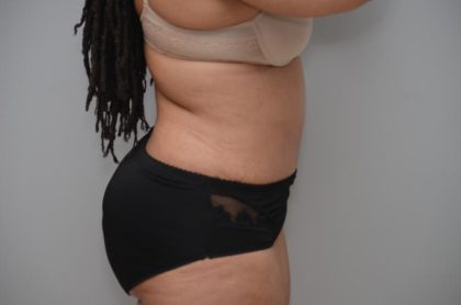 Abdominoplasty Before & After Patient #3185