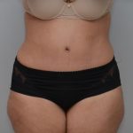 Abdominoplasty Before & After Patient #3185