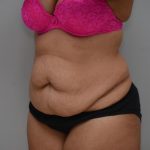 Abdominoplasty Before & After Patient #3185