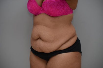 Abdominoplasty Before & After Patient #3185