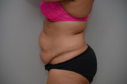 Abdominoplasty Before & After Patient #3185