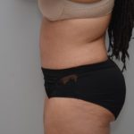 Abdominoplasty Before & After Patient #3185