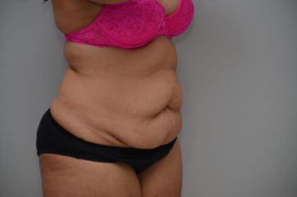 Abdominoplasty Before & After Patient #3185