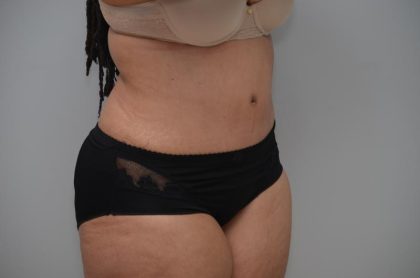 Abdominoplasty Before & After Patient #3185