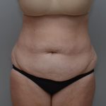 Abdominoplasty Before & After Patient #3186