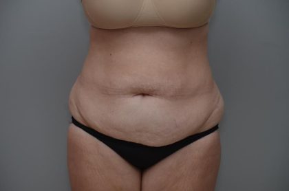 Abdominoplasty Before & After Patient #3186