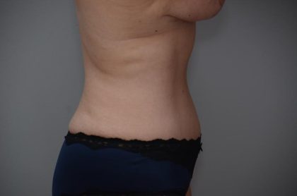 Abdominoplasty Before & After Patient #3186