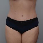Abdominoplasty Before & After Patient #3186