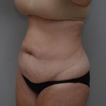 Abdominoplasty Before & After Patient #3186