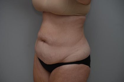 Abdominoplasty Before & After Patient #3186