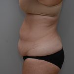 Abdominoplasty Before & After Patient #3186