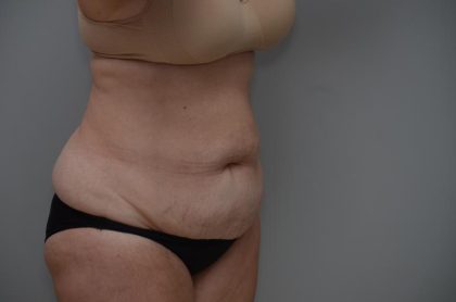 Abdominoplasty Before & After Patient #3186